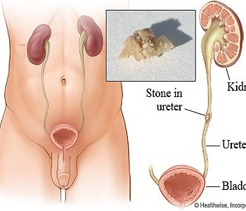 kidney stones problem during urine